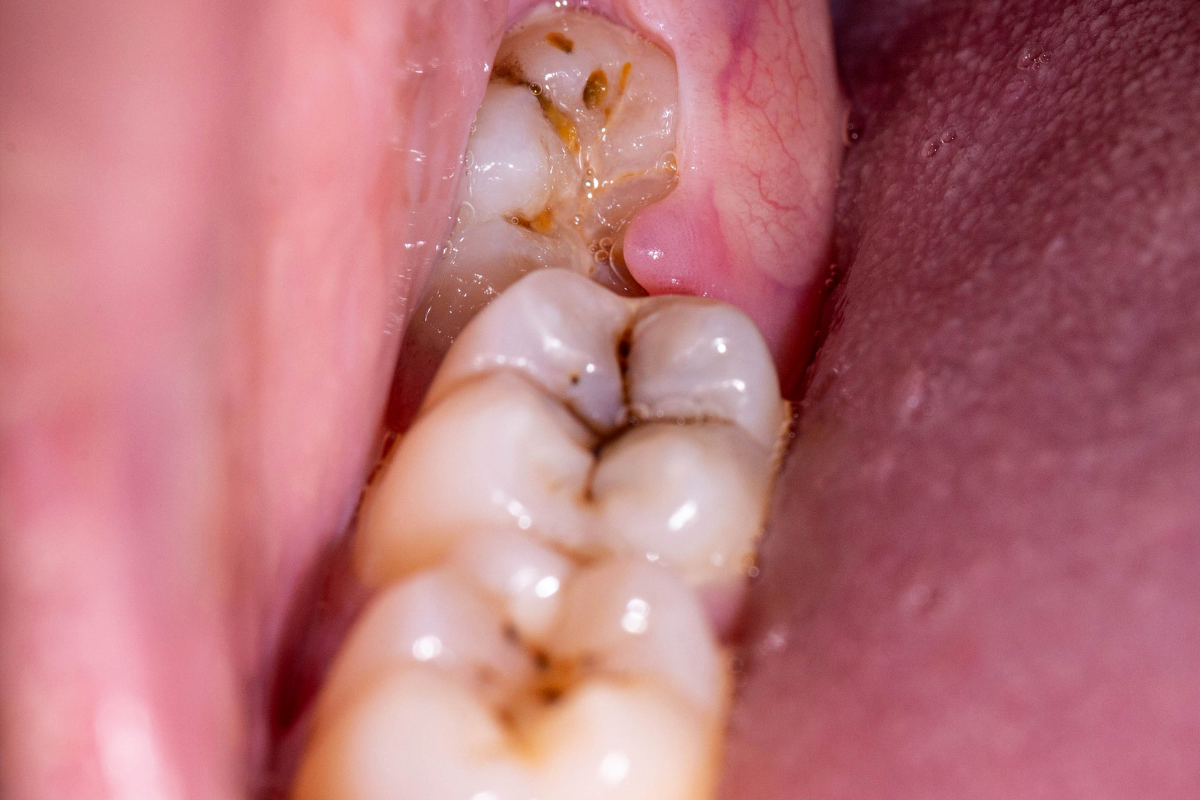 Featured image for “Common Wisdom Teeth Problems and What to Do About Them”
