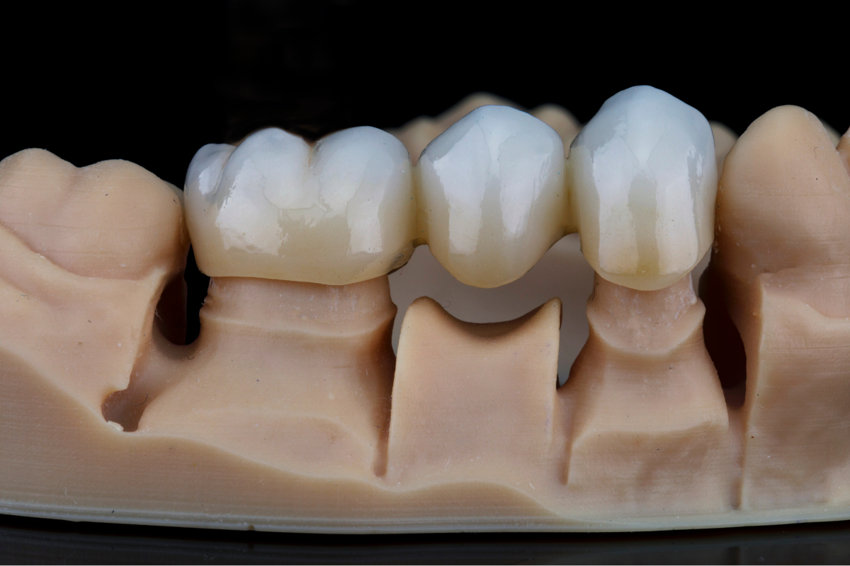 Dental Crowns