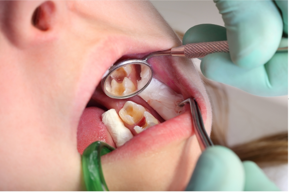 Featured image for “Revealing Why Some People Are More Prone to Cavities”