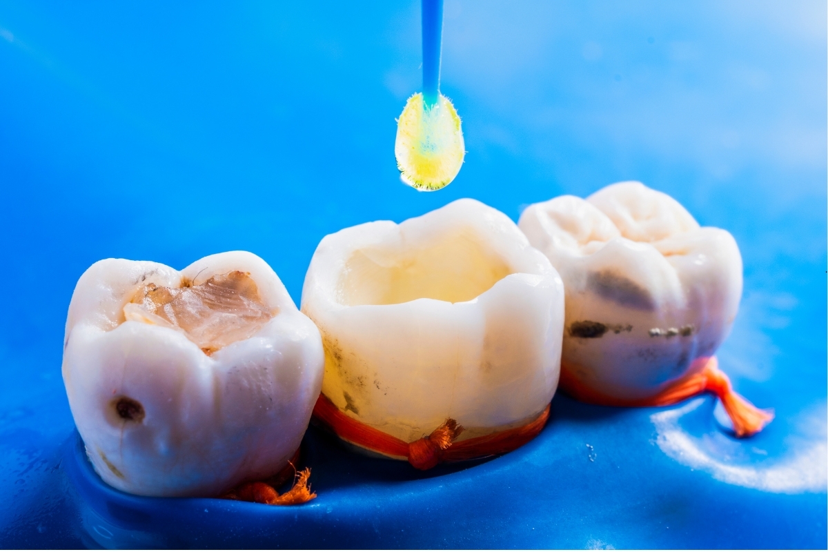Featured image for “How to Take Care of Your Dental Filling”