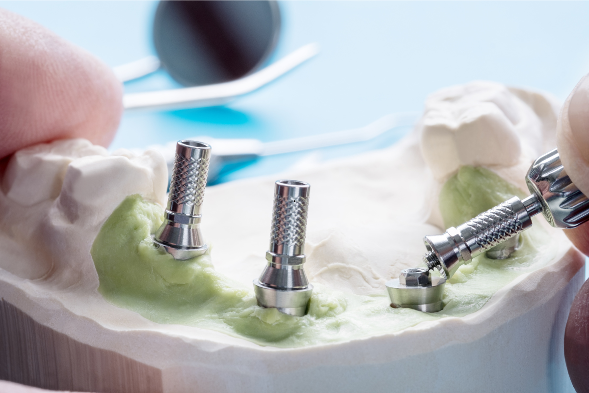 Featured image for “Dental Abutment Implants Explained: A Complete Guide to the Implant Process”