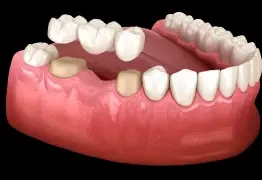Dental bridge restoration showing replacement teeth attached to natural teeth on a gum model.